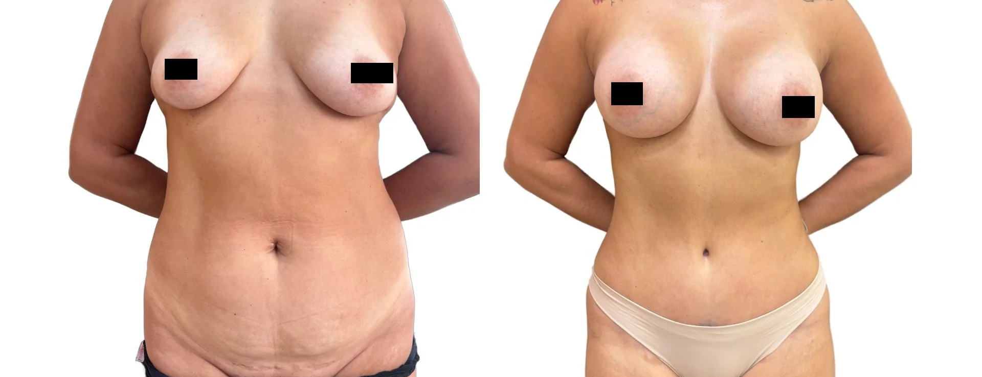 Resultado educativo de cirurgia de mama e abdômen em vista frontal