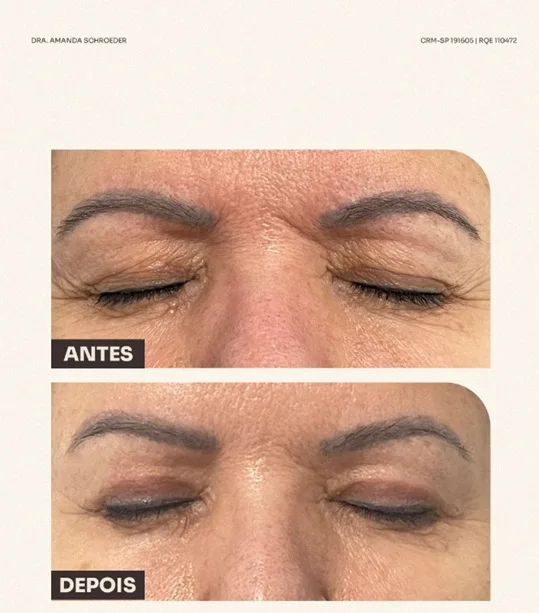 Resultado educativo de blefaroplastia superior